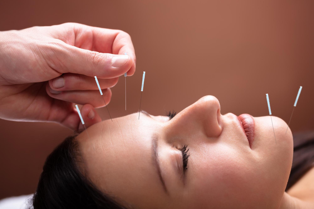 acupuncture in Hallandale Beach