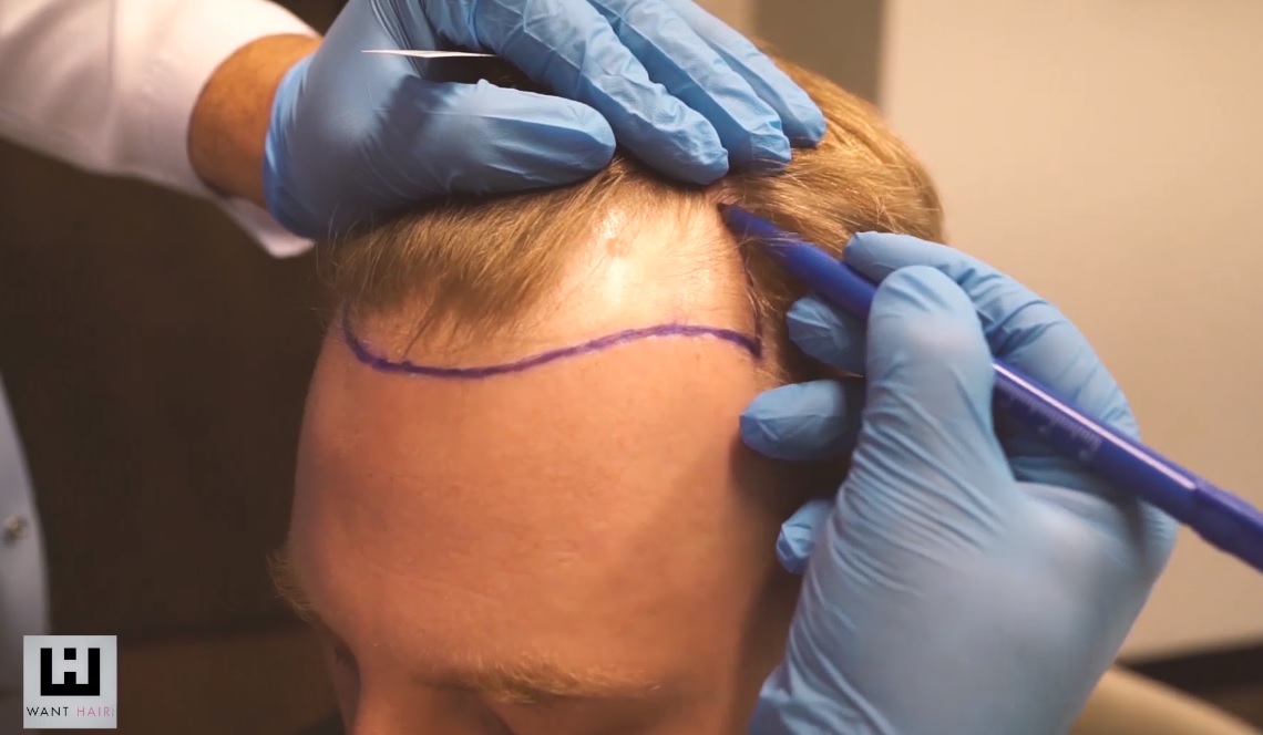 Best Hair Transplant in Istanbul Becomes More Accessible Through Want Hair Ltd