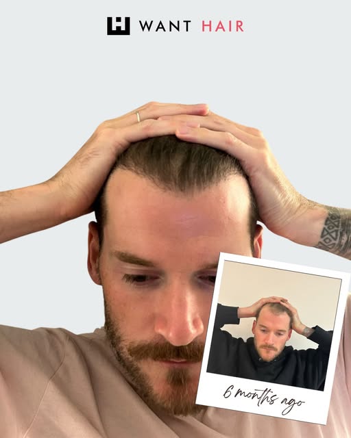 Discover Why Want Hair Ltd Is Becoming a Trusted Name for Best Hair Transplant in Turkey