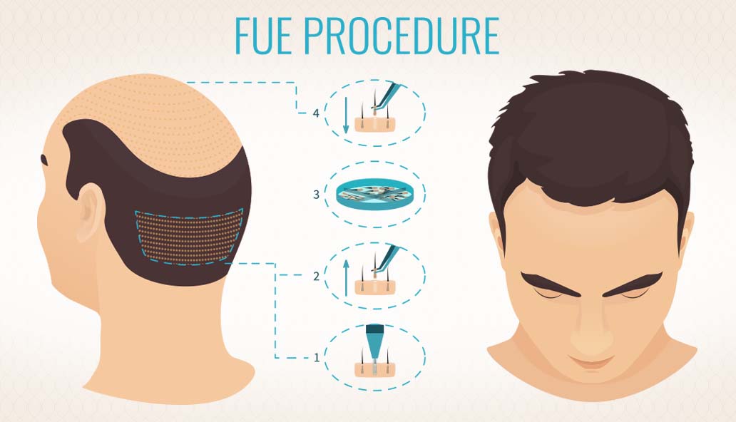 FUE Hair Transplant Istanbul, Turkey: Want Hair Ltd Showcases Natural-Looking Results