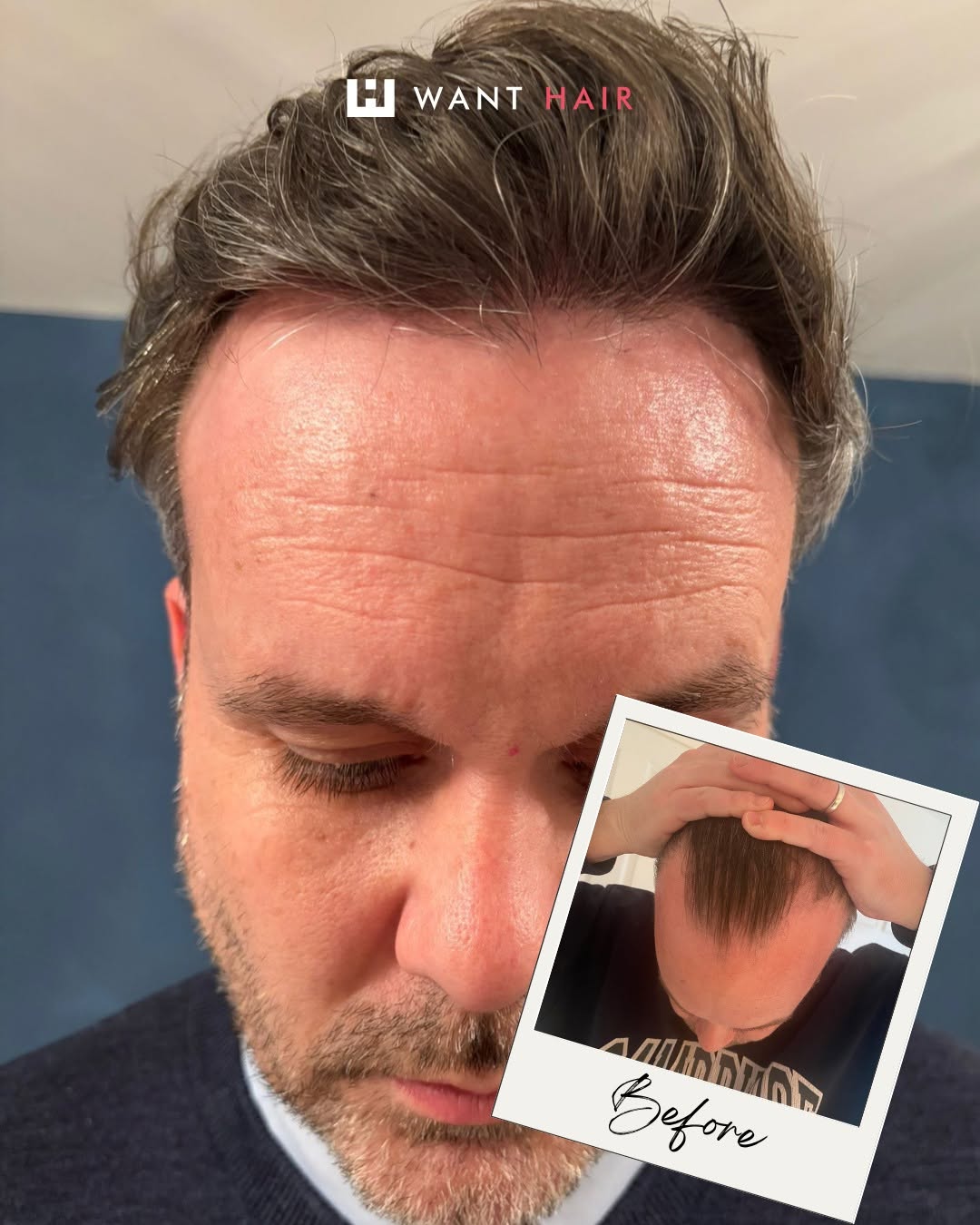 Hair Loss Treatment UK